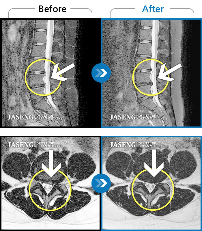 인천자생한방병원 치료사례 MRI로 보는 치료결과-허리 양쪽과 골반, 양측 다리까지 다 아파요