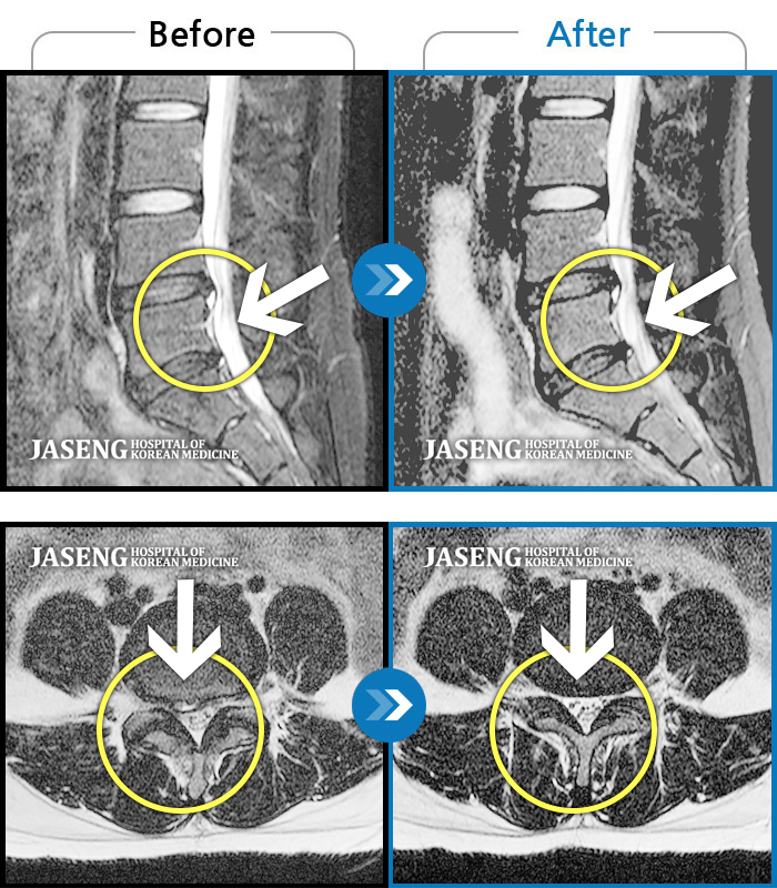 인천자생한방병원 치료사례 MRI로 보는 치료결과-우측 다리 바깥쪽으로 저린 감이 지속적으로 있어요.