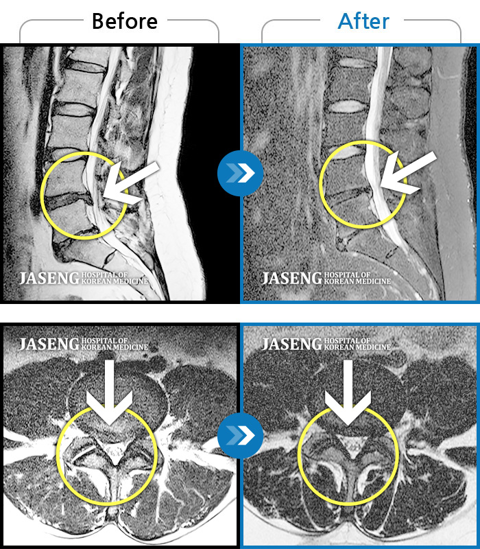 인천자생한방병원 치료사례 MRI로 보는 치료결과-다리 통증이 심해서 걷기가 힘들어요.