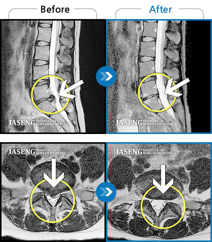 인천자생한방병원 치료사례 MRI로 보는 치료결과-요통과 다리 통증