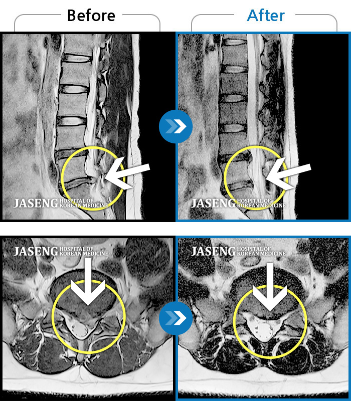 인천자생한방병원 치료사례 MRI로 보는 치료결과-허리부터 왼쪽 다리로 통증이 있고 저려요