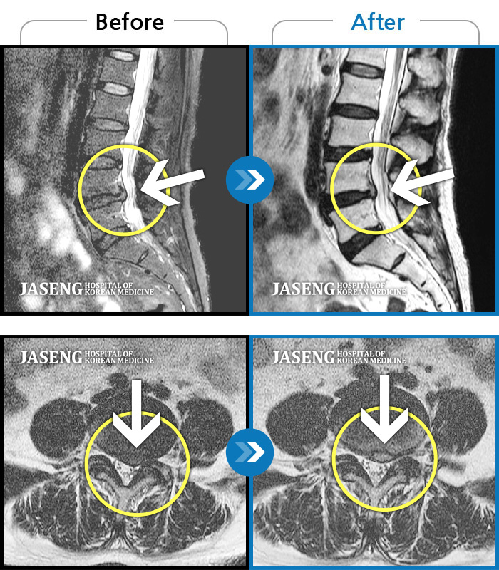 인천자생한방병원 치료사례 MRI로 보는 치료결과-좌측 골반 통증과 다리 저림이 오래 걸으면 심해져요