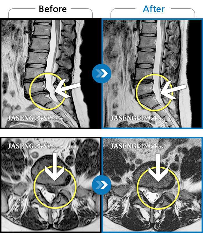인천자생한방병원 치료사례 MRI로 보는 치료결과-일상생활이 힘들 정도의 허리 통증과 왼쪽 다리 통증