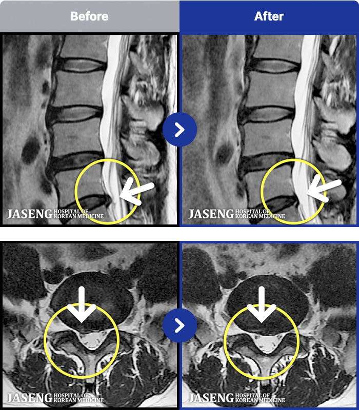 ���ڻ��ѹ溴�� ġ���� MRI�� ���� ġ����-������ ��ݺ��� ��������� �������� ���� ����