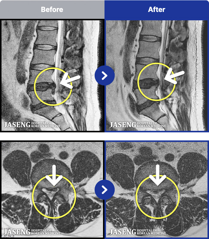 ��õ�ڻ��ѹ溴�� ġ���� MRI�� ���� ġ����-������ ���ϰ� ���� �ٸ� ������ ���� ���� �׸��� ���� �߰��� �ٷ� ���Ϸ� �ϻ��Ȱ�� ����� ���¿����ϴ�.