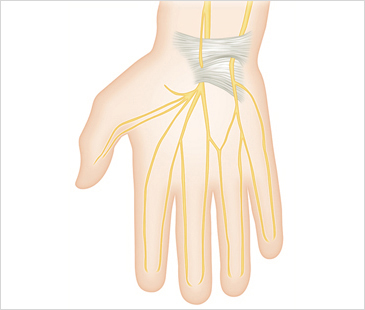인천자생한방병원 기타관절질환 손목터널증후군-손목터널증후군에 관련된 이미지 입니다.