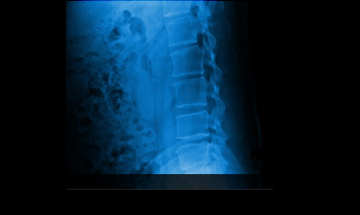 인천자생한방병원 허리질환 척추후만증-척추후만증에 관련된 이미지 입니다.