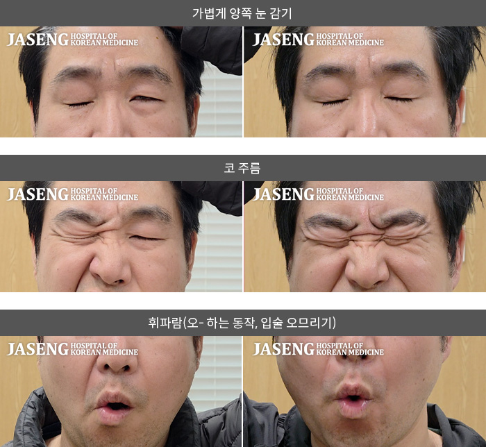 보라매자생한방병원-안면신경마비 치료 사례